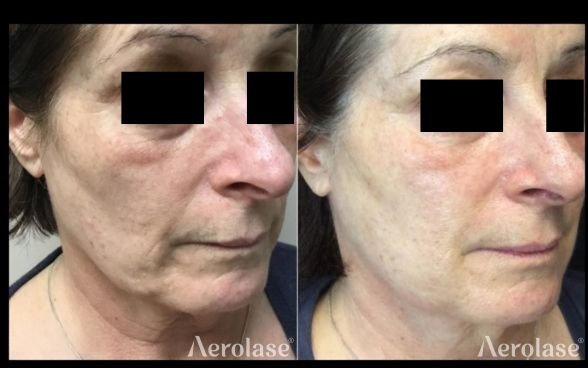 Skin Rejuvenation Face 