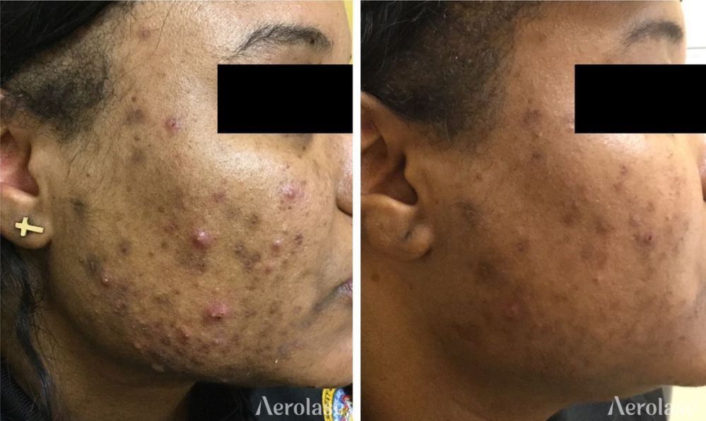 Acne - 1 Treatment - Chesahna Kindred MD