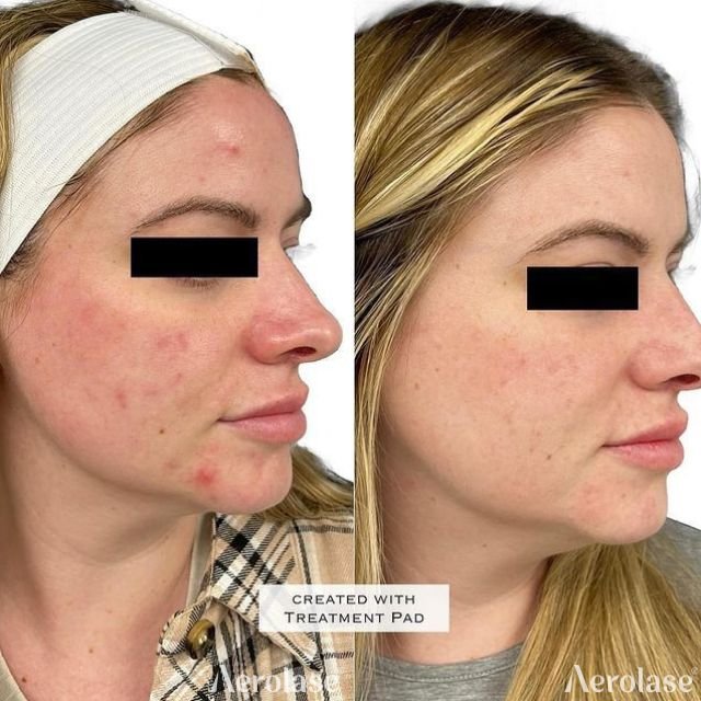 Acne - 3 Treatments - Aesthetic RN Jen 1 of 2 - Side View 