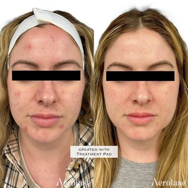 Acne - 3 Treatments - Aesthetic RN Jen 2 of 2 - Front View