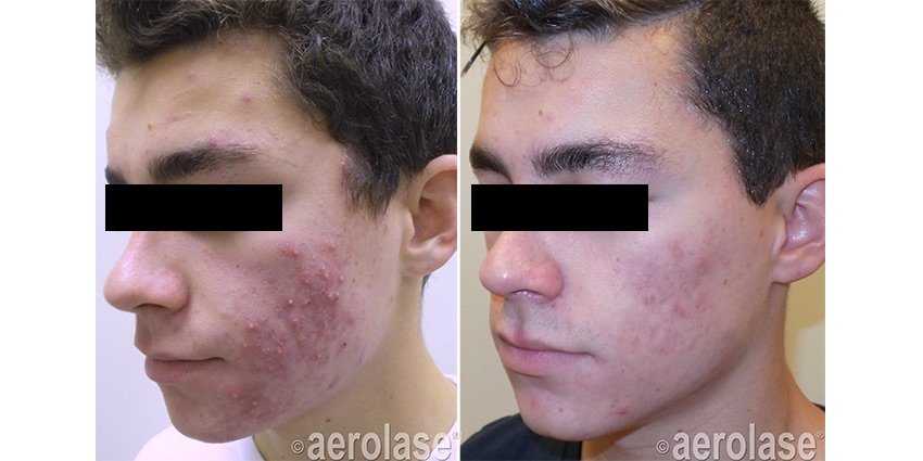 Acne - 4 Treatments - Kevin Pinski MD