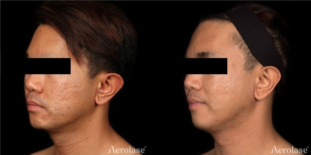 Acne Scars Face - Jason Emer MD 