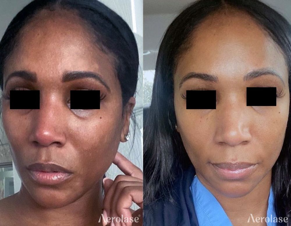 Melasma Face - LaMone Aesthetics