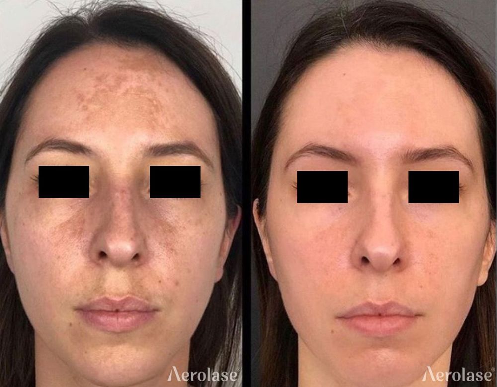 Melasma Face - 1 Treatment - Avanti Aesthetic Academy