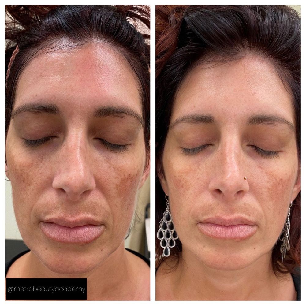 Melasma - Metrobeautyacademy