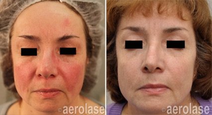 Rosacea - Aerolase 