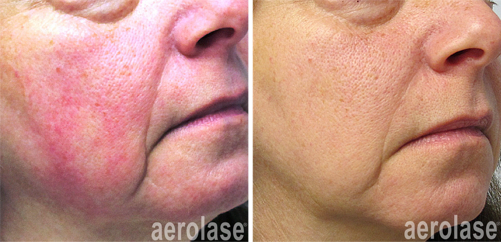 Rosacea - 1 treatment -yelena-kipervas -MD