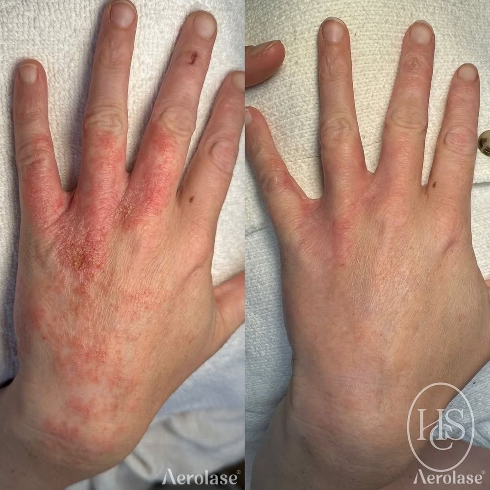 Psoriasis Hands - Holistic Skin Co 