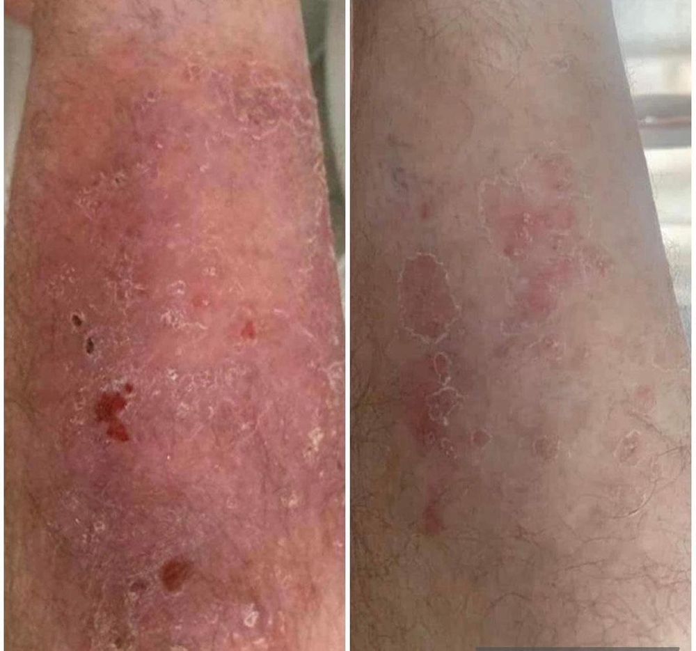 Psoriasis - Sante Second Regard