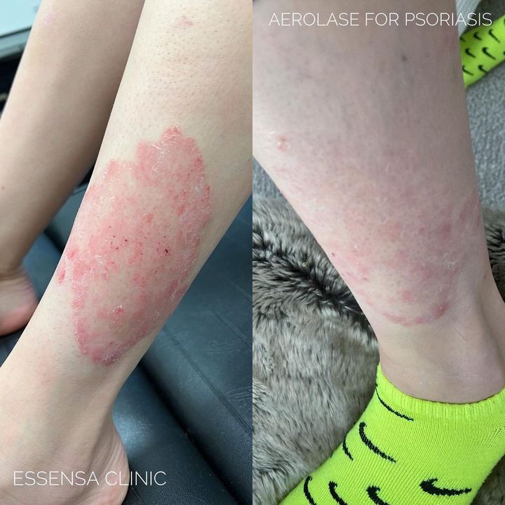 Psoriasis - Essensa Clinic 