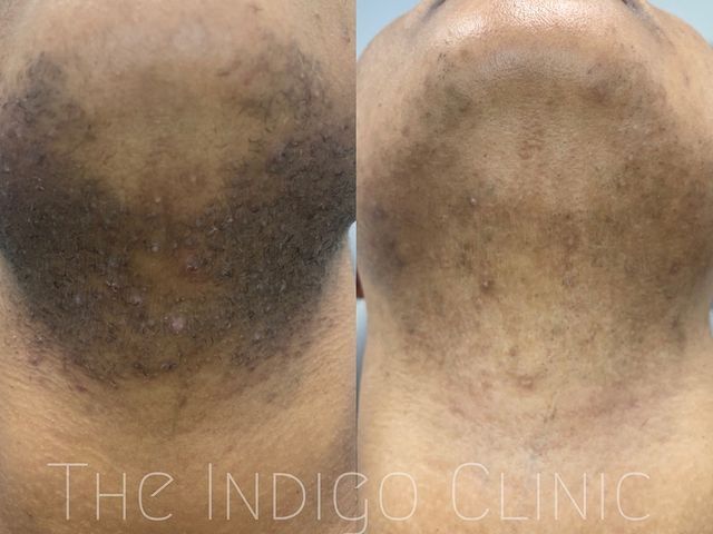 PFB - The Indigo Clinic