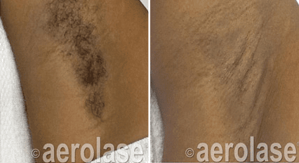 Hair Removal4 - Pair