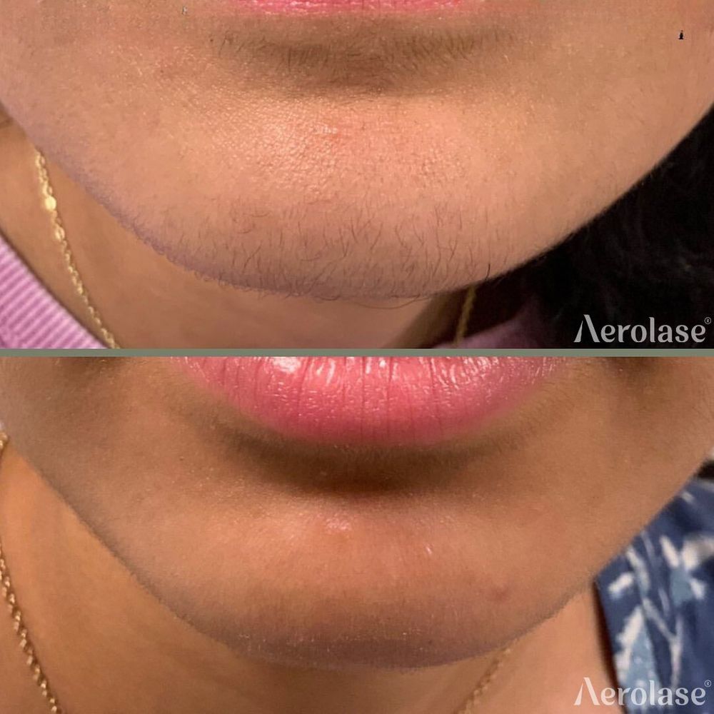 Hair Removal - Nicole Osterling
