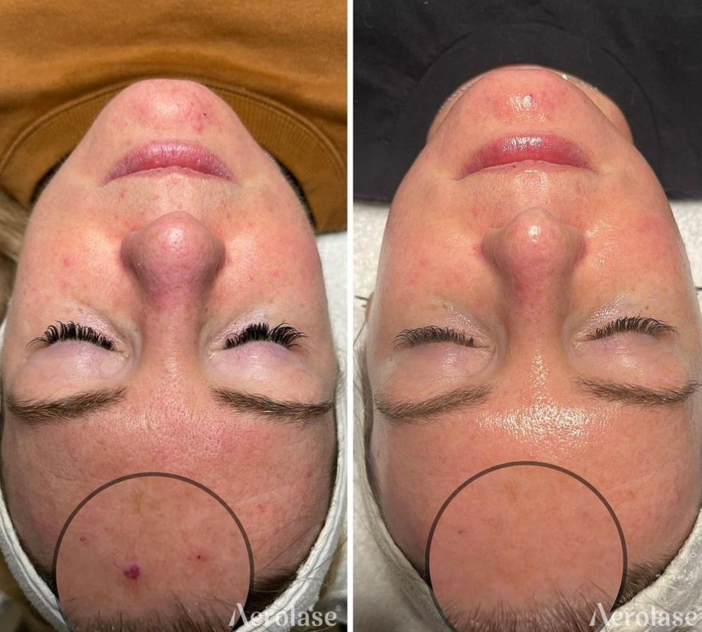 Cherry Angiomas - Urban Retread Derm Spa 
