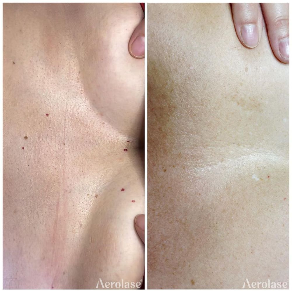 Cherry Angiomas - 1 Treatment - Urban Retreat Derma Spa