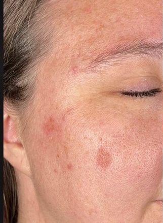 Hyperpigmentation - Aerolase 2_crop_322_439