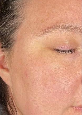 Hyperpigmentation - Aerolase 2_crop_311_437