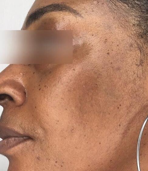 Melasma - Sholema Clinics_crop_451_521