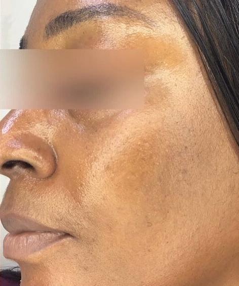 Melasma - Sholema Clinics_crop_437_524