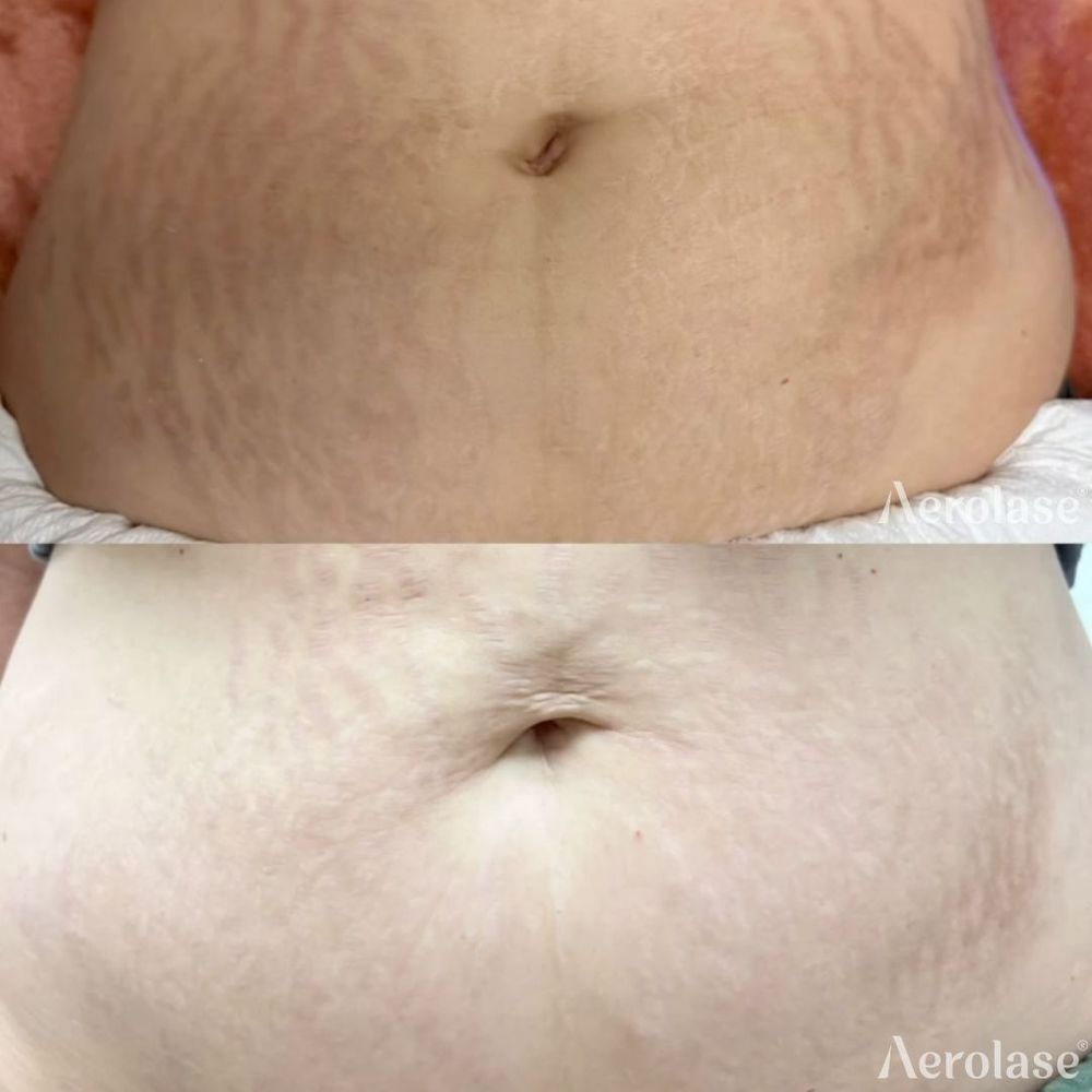 Stretch Marks Stomach - Goddess Aesthetic 