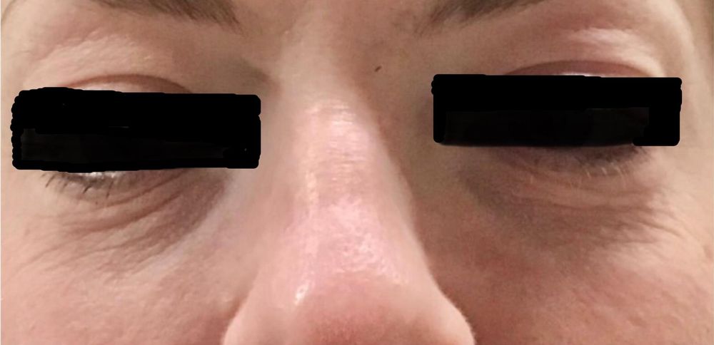 undereye prp_edit_crop_979_474