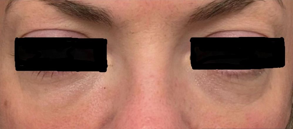 undereye prp_edit_crop_976_431