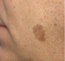 Pigmented Spots2 - Pair_crop_212_200