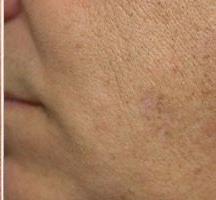 Pigmented Spots2 - Pair_crop_216_200