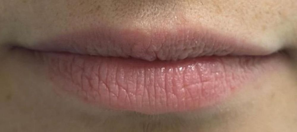 Lip Rejuvenation - 1 Treatment - Aerolase_crop_990_442