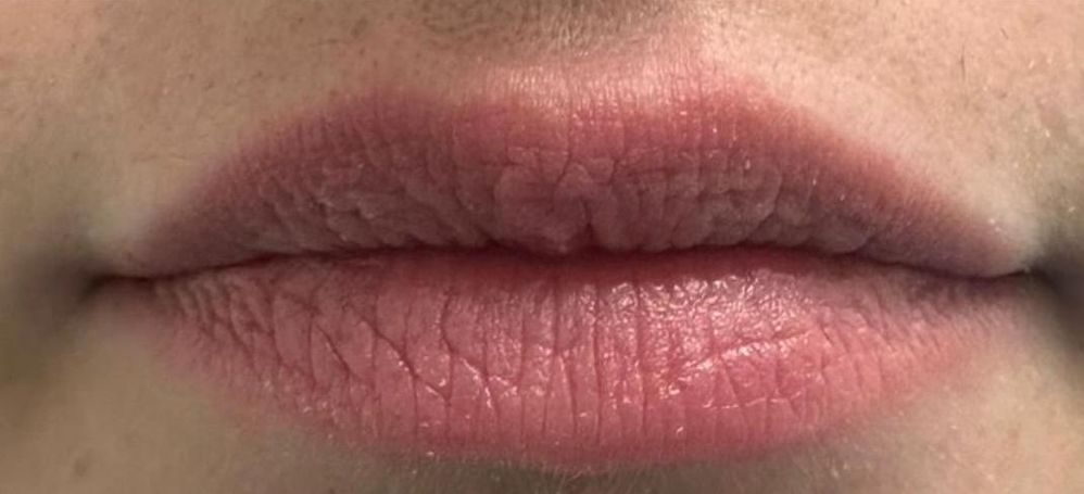 Lip Rejuvenation - 1 Treatment - Aerolase_crop_989_451