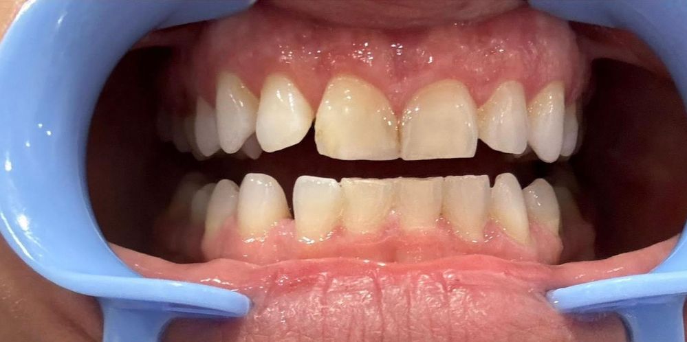 before teeth