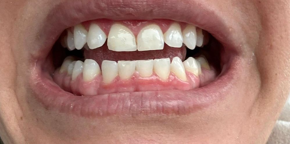 after teeth