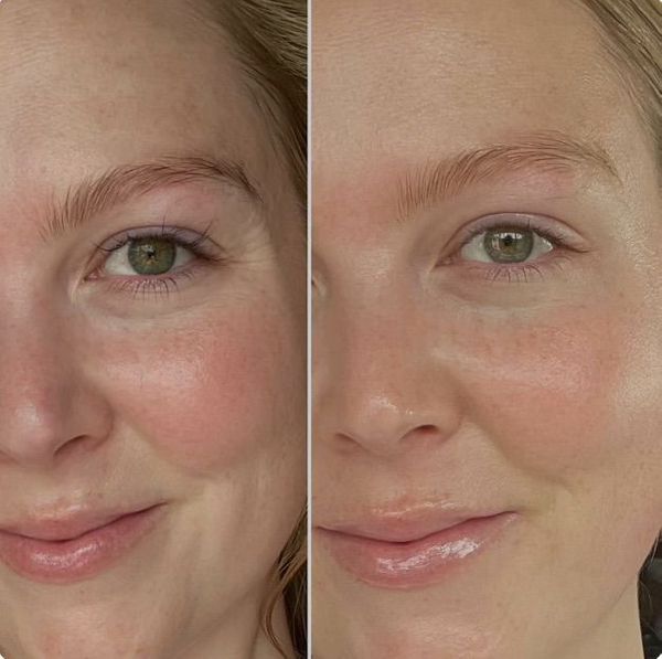 before and after of young woman after using skincare products