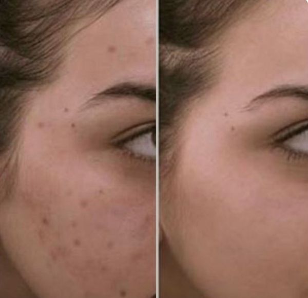 before and after of young woman after using skincare products for help with dark spots